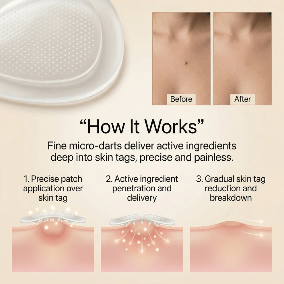 SKIN TAG REMOVER (BUY 1 GET 1 FREE)